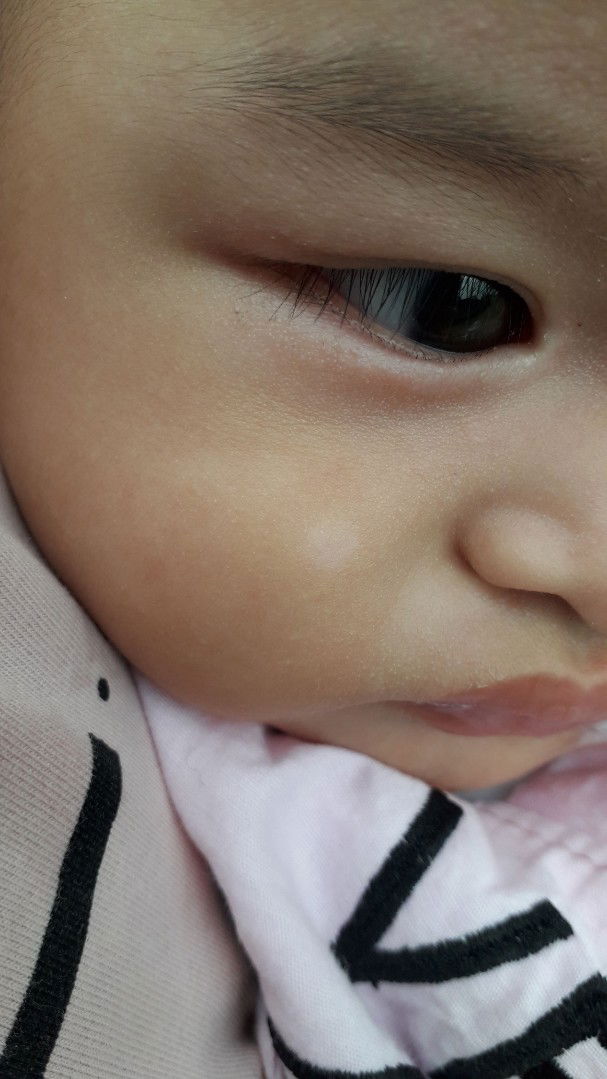 Putih dimuka bayi seperti panu