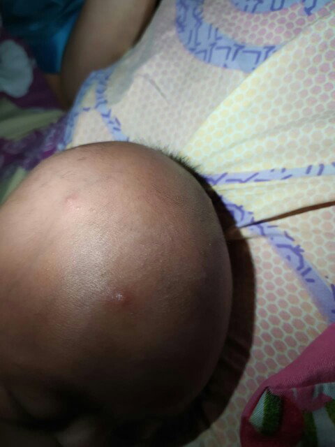 benjolan kecil