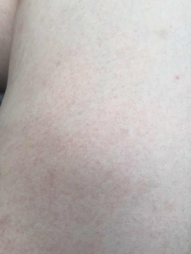 Bintik merah pada paha