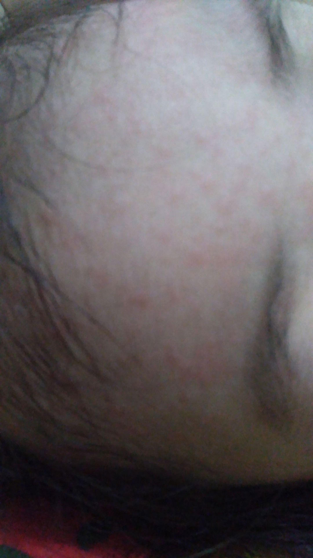 Apakah ini cacar air ???