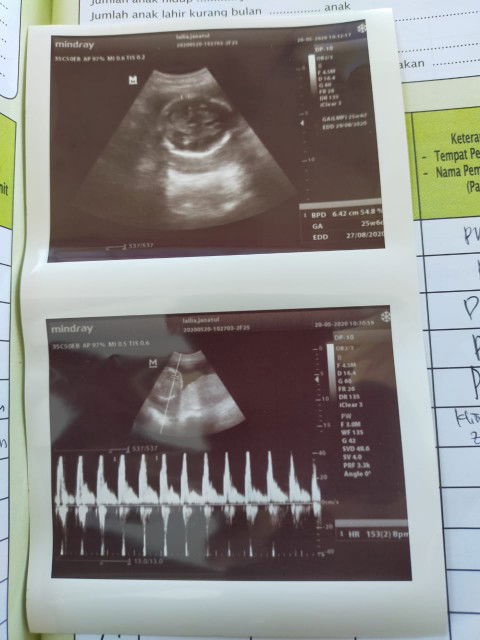 letak plasenta di bawah