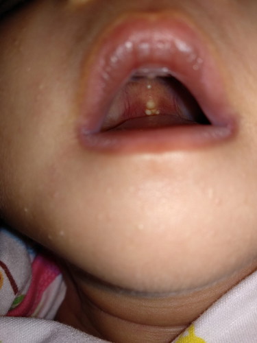 cara mengatasi bapil baby 14hari