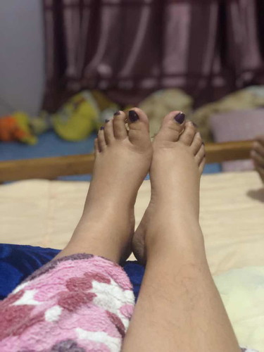 Foot edema