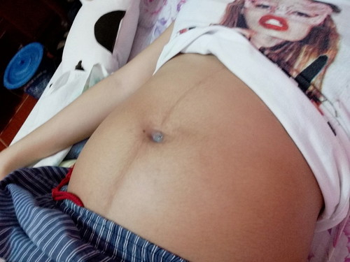 Stretchmarks