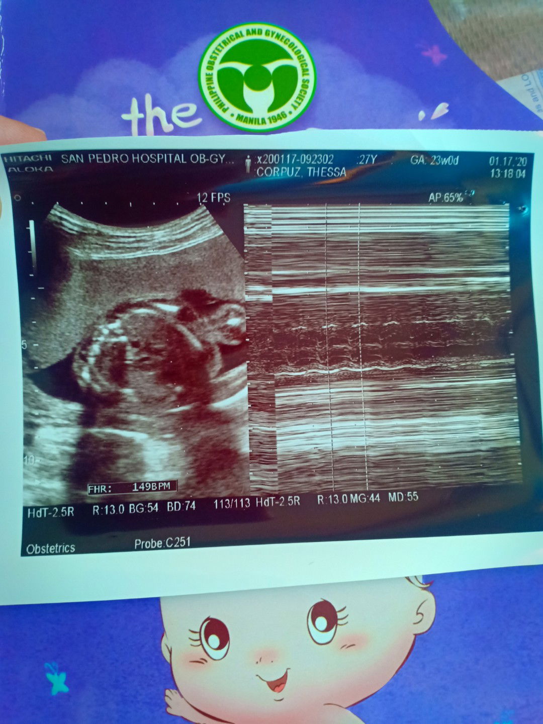 Ultrasound