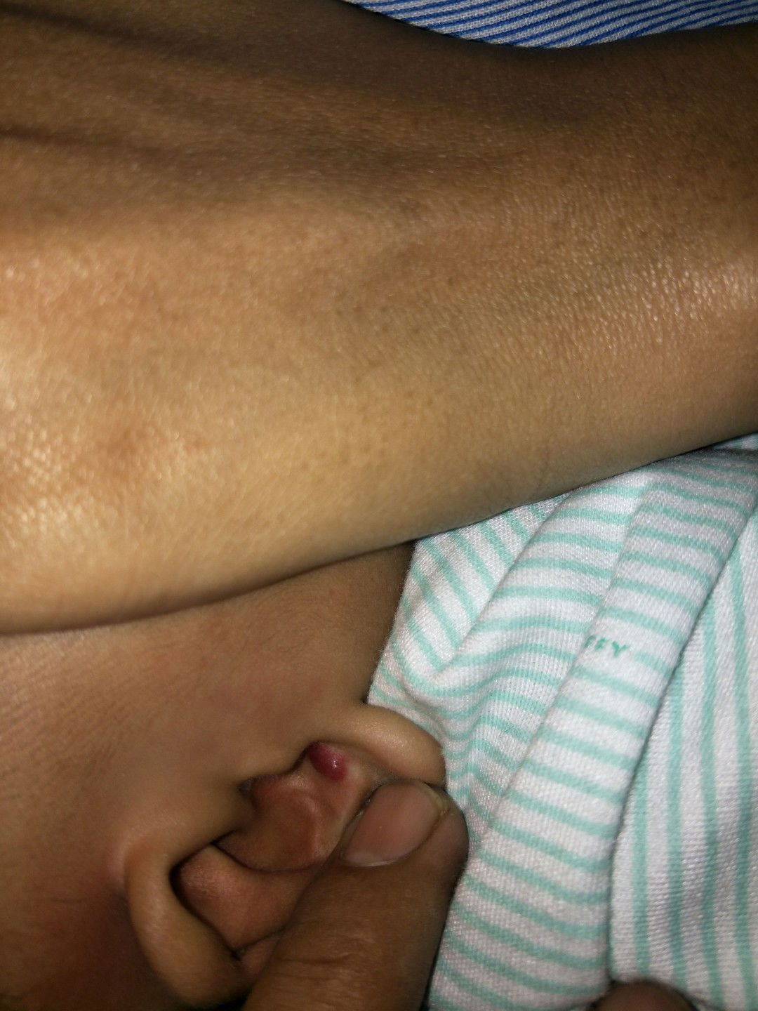 benjolan darah beku di bayi