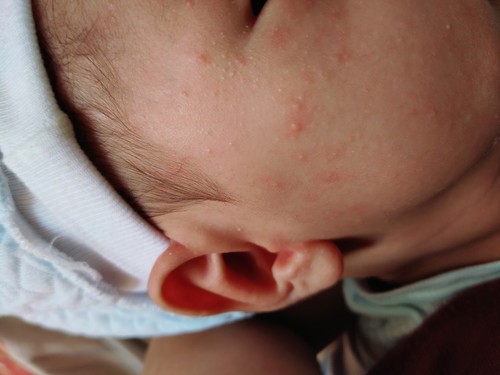 Baby Acne
