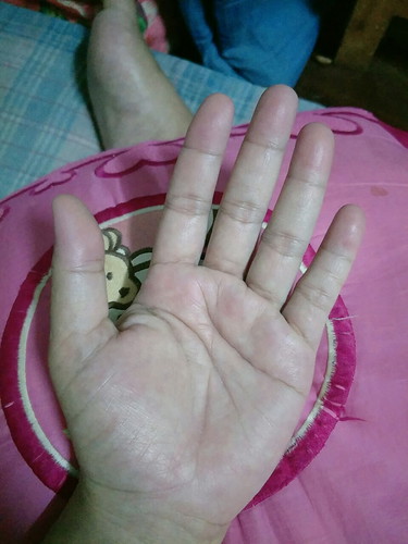 แม่ท่านไหนเป็นบ้างชาที่ปลายนิ้วมือ
