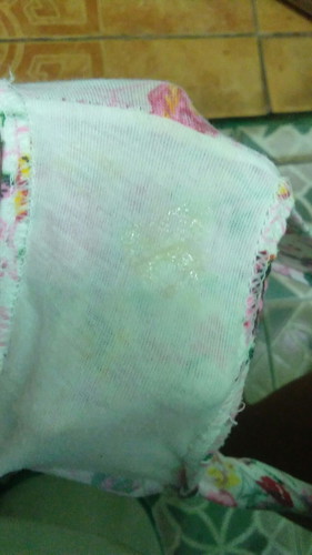 Mucus Plug