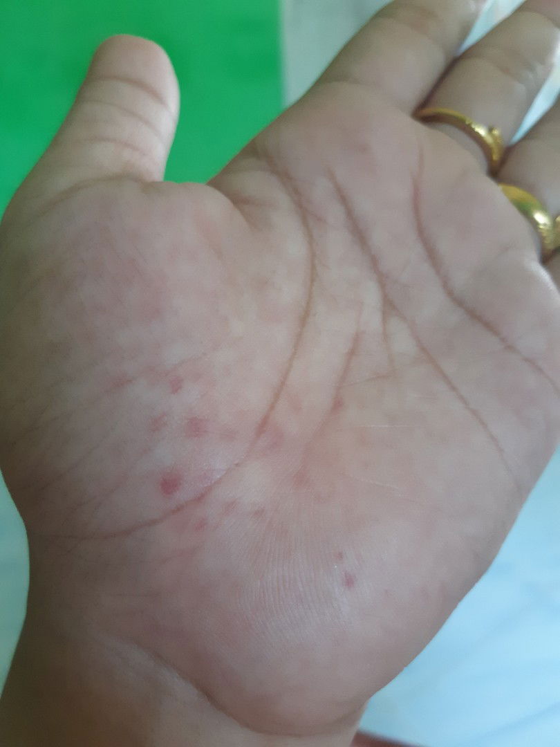 Bintik merah di telapak tangan