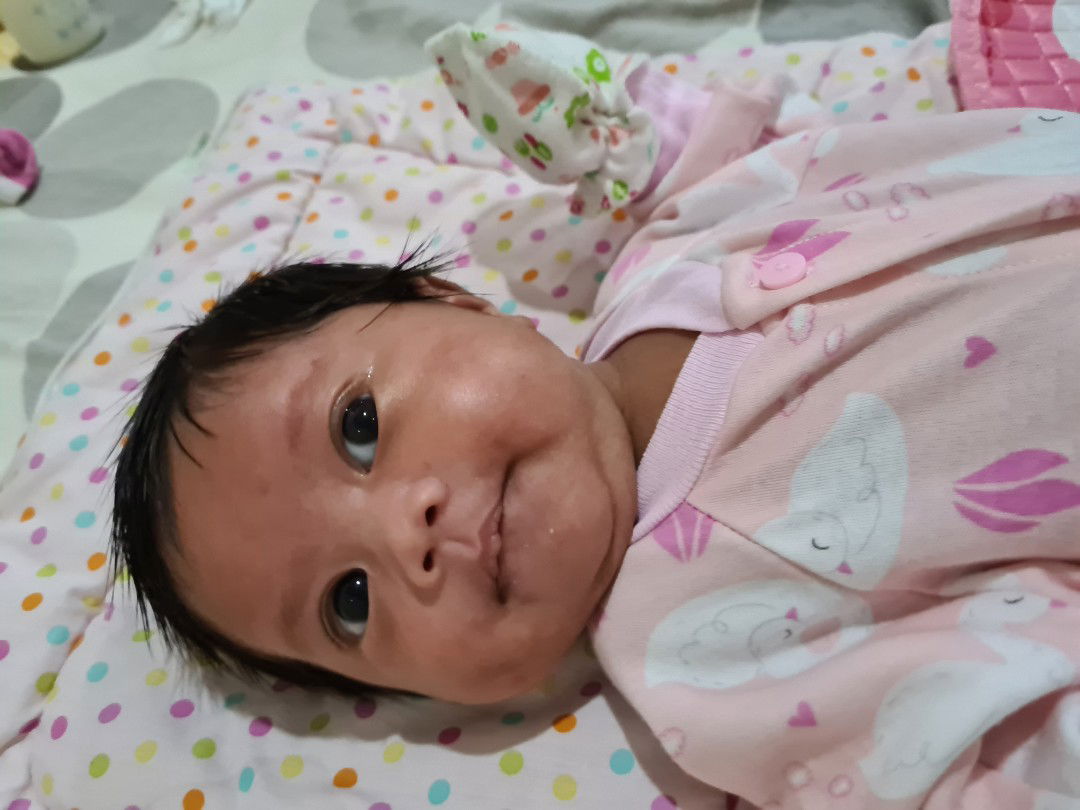 Masih nyeri setelah operasi caesar 1 bulan yg lalu.