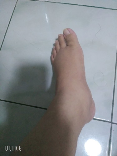 ขาบวม