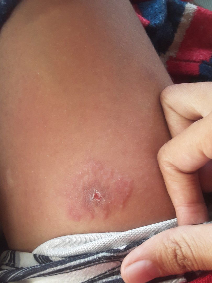 เเม่บ้านไหนเคยโดนเห็บลมกัดบ้างคะ