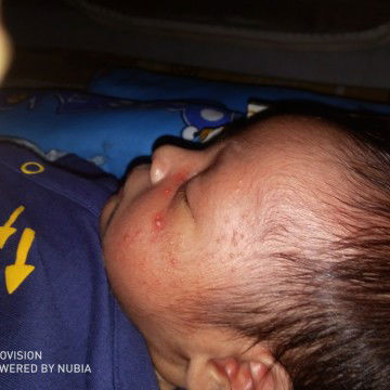 jerawat bayi