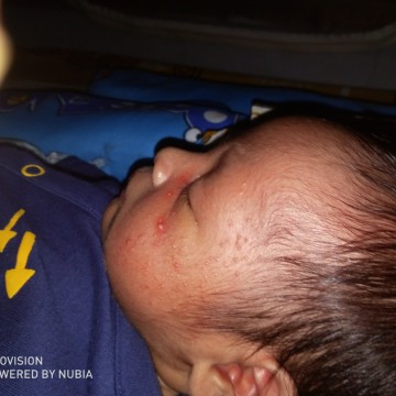 jerawat bayi