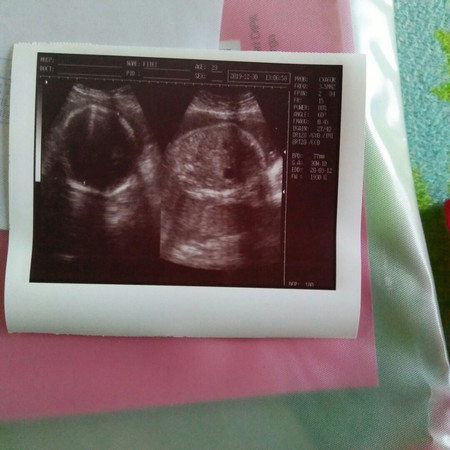 hasil usg 30mg apa ini bertanda janin sehat??karna saya kurang ngerti