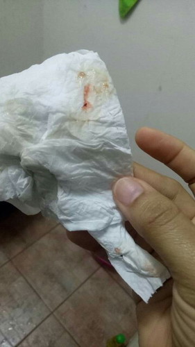 มีเลือดออก