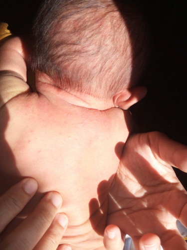 bentol bentol pd anak bayi baru lahir