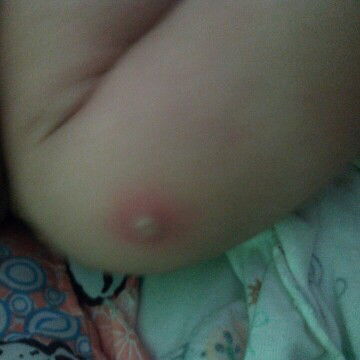 bekas suntikan imunisasi