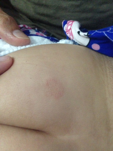 Ringworm or Not?