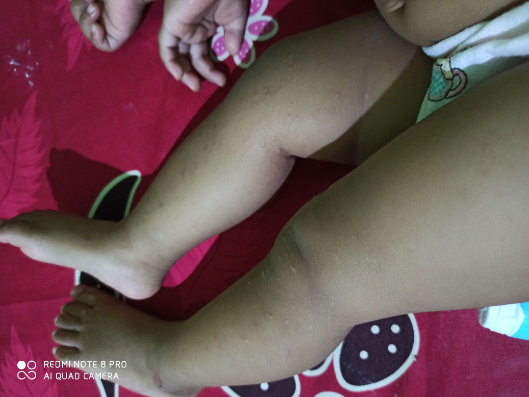 gatal pada bayi 10bulan