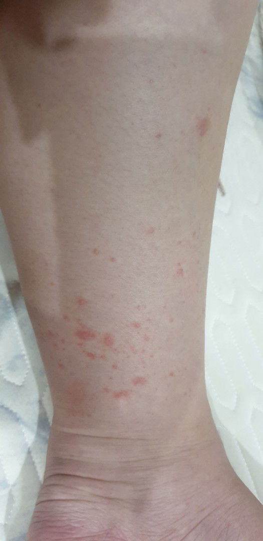 mẩn ngứa khi bầu bí