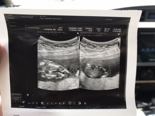 ซาวด์ 16 week ท่านอนคว่ำ ชัวร์หรือมั่วกันแน่