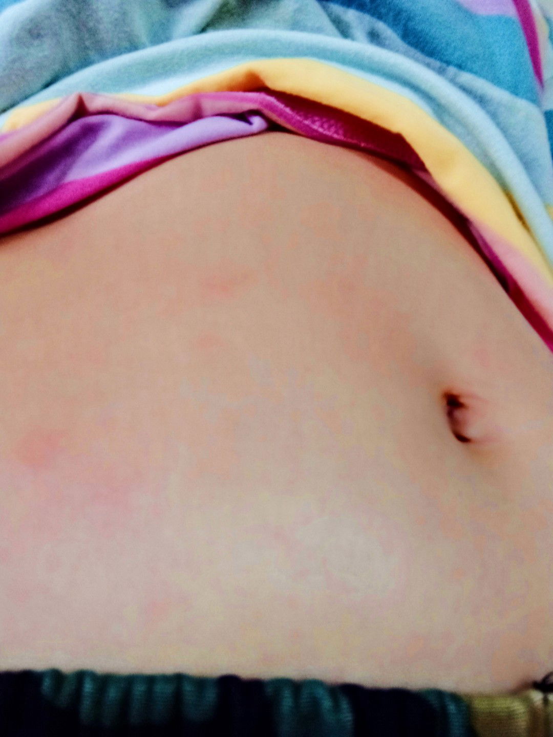 แม่ท้องเป็นผื่นแดง