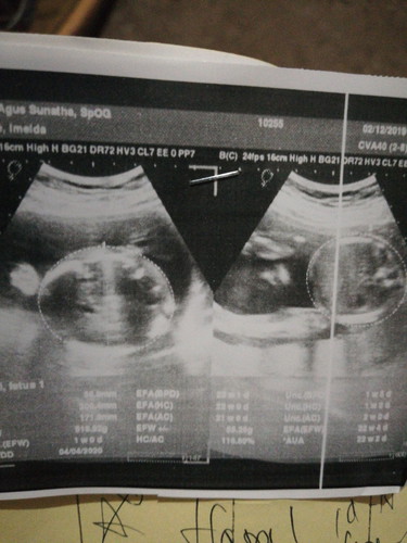 Hasil USG