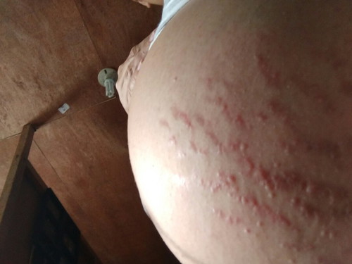 itchy stretch mark