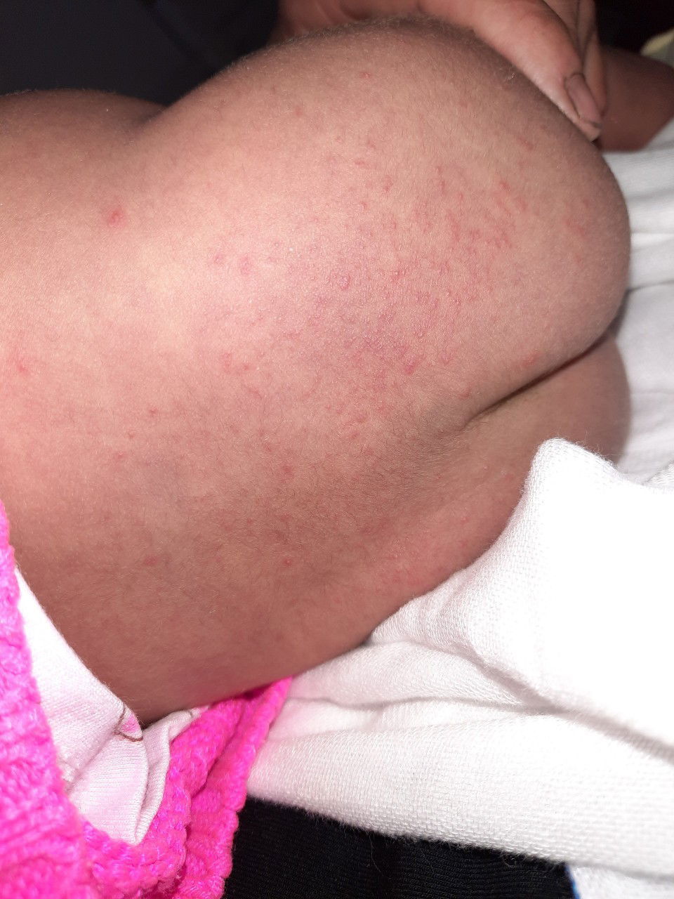 trẻ bị nổi mụn ở vùng mông và lưng