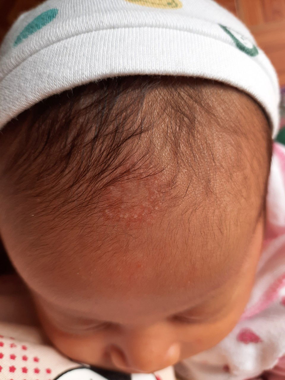 dấu hiệu hắc lào