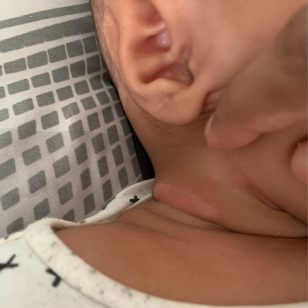 Baby Neck Rash