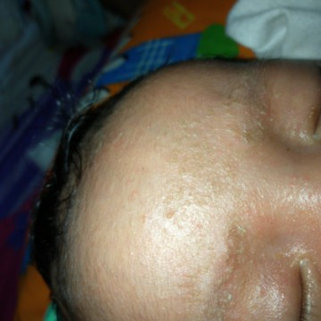 Rashes