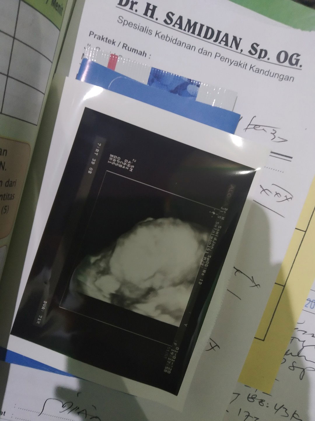 mengatasi bayi sungsang