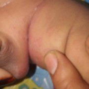 Merah-merah plus kayak ada bentol-bentol