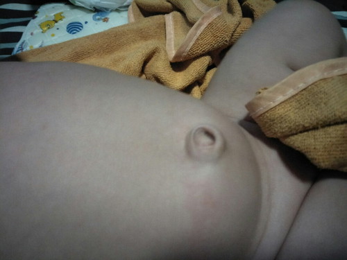 สะดือจุ่น