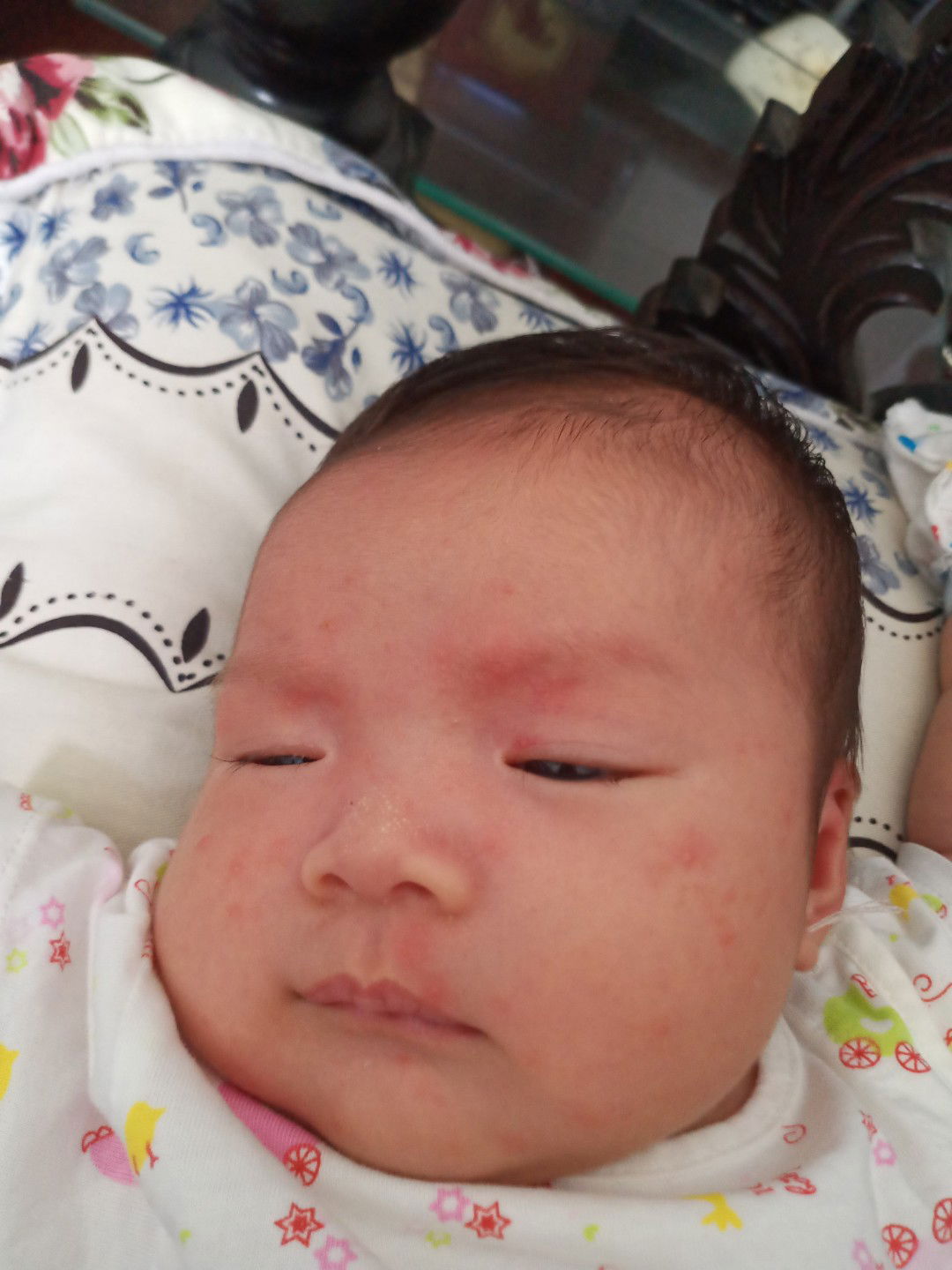 mụn đầu cổ lưng tay