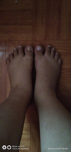 Swollen feet