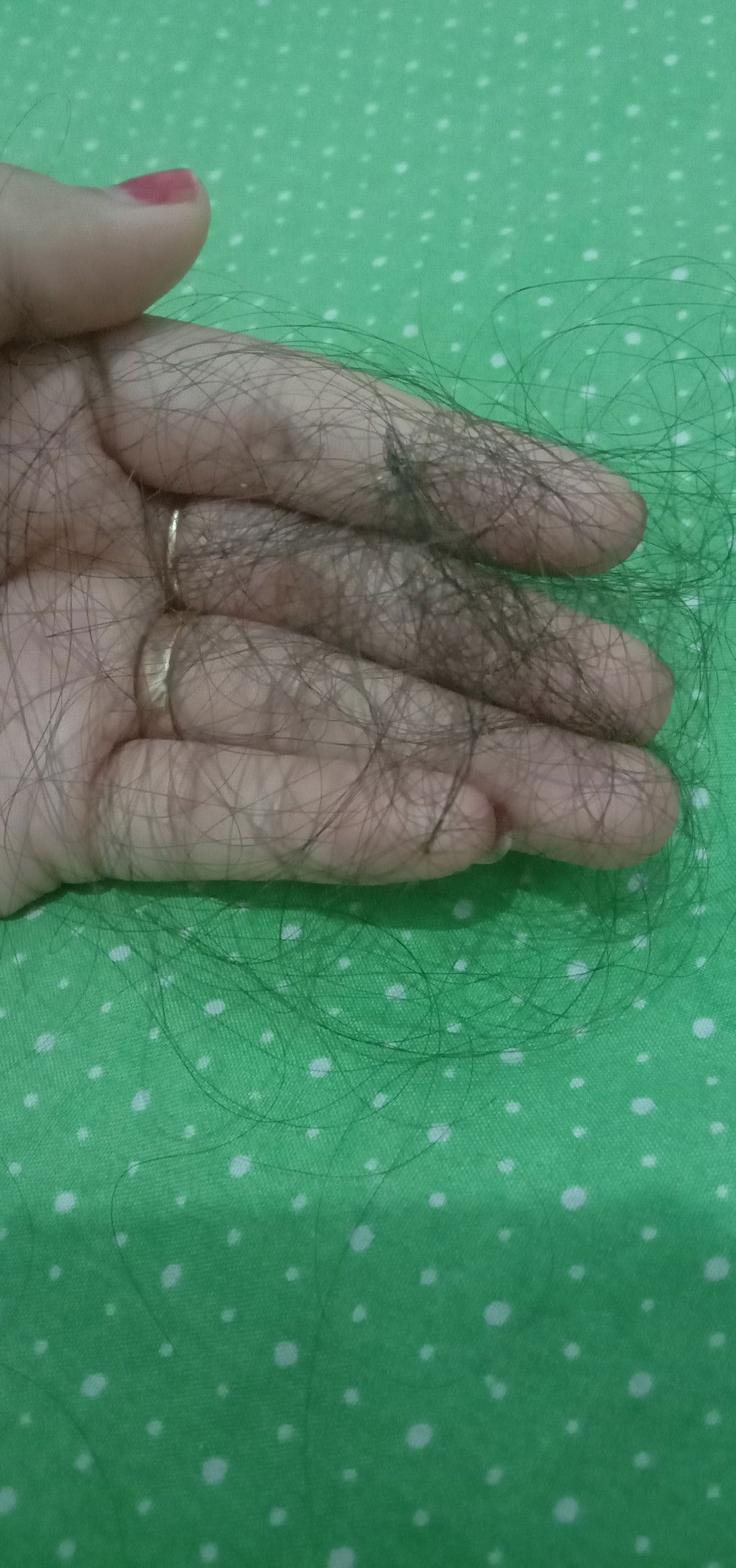 Post partum hair loss