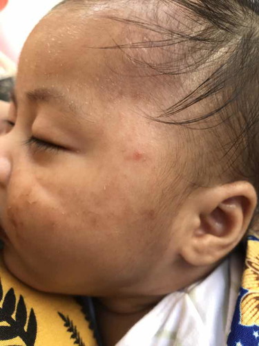 Bundd klo anak g sembuh2 gatal mukak nya dikasih apa ya?Sudah nyobak pkek apa aja