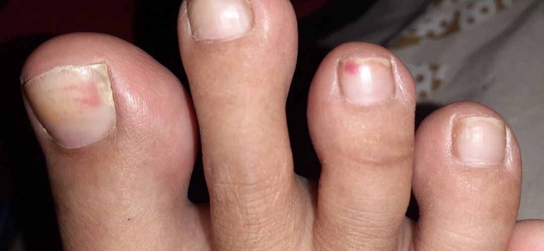 kaki bengkak dan kuku merah