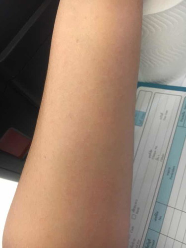 ผื่นคันขึ้นตามตัว