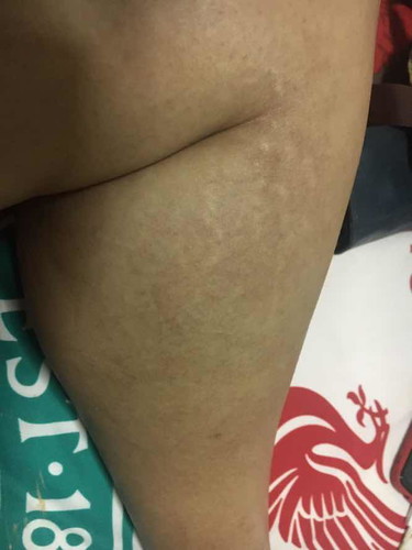 รอยดำที่ขา