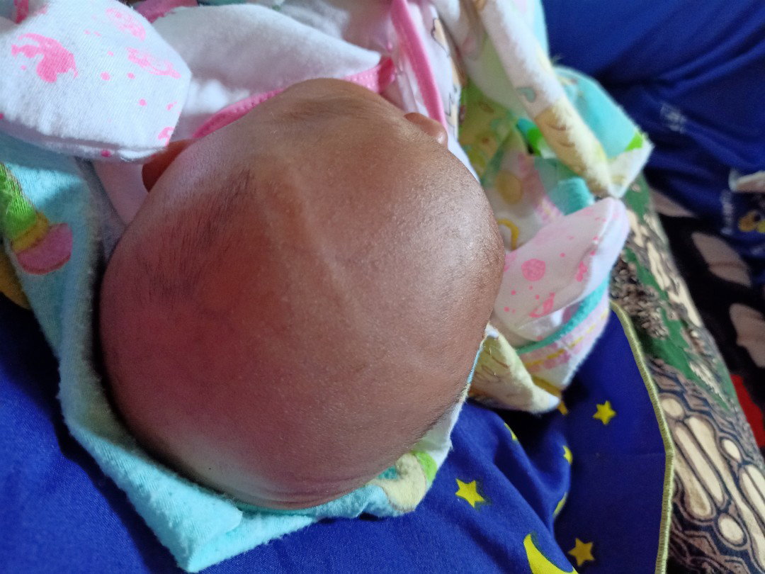 kepala bayi ada garis
