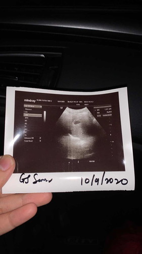 Tiada janin and jantung. 6week