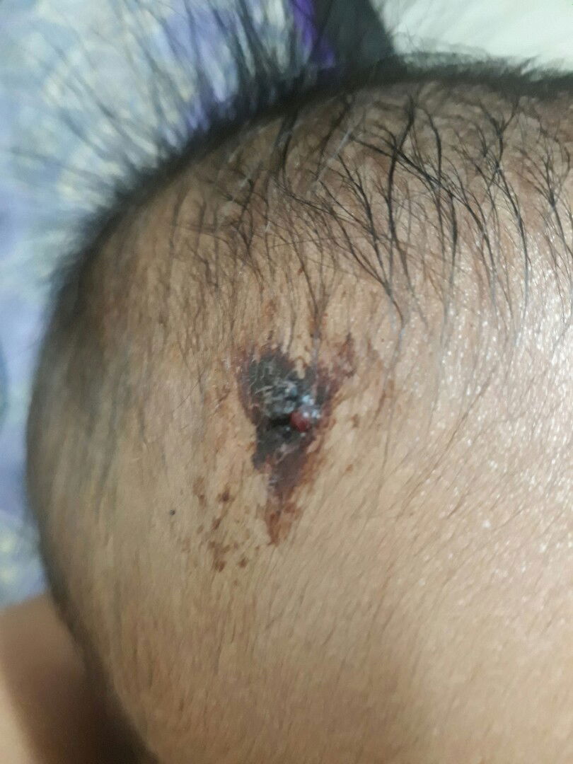 Nunal po sya na red tpus nakamot nya dumugo