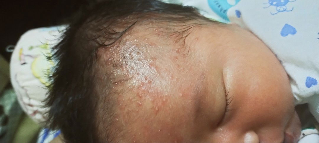 bintik-bintik di kepala