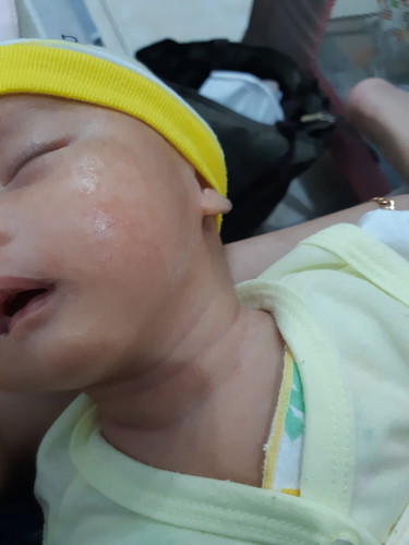 bayi baru lahir beruntusan