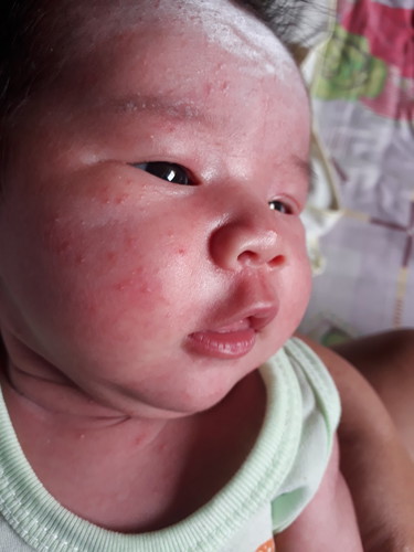 ผื่นขี้นน่าลูก